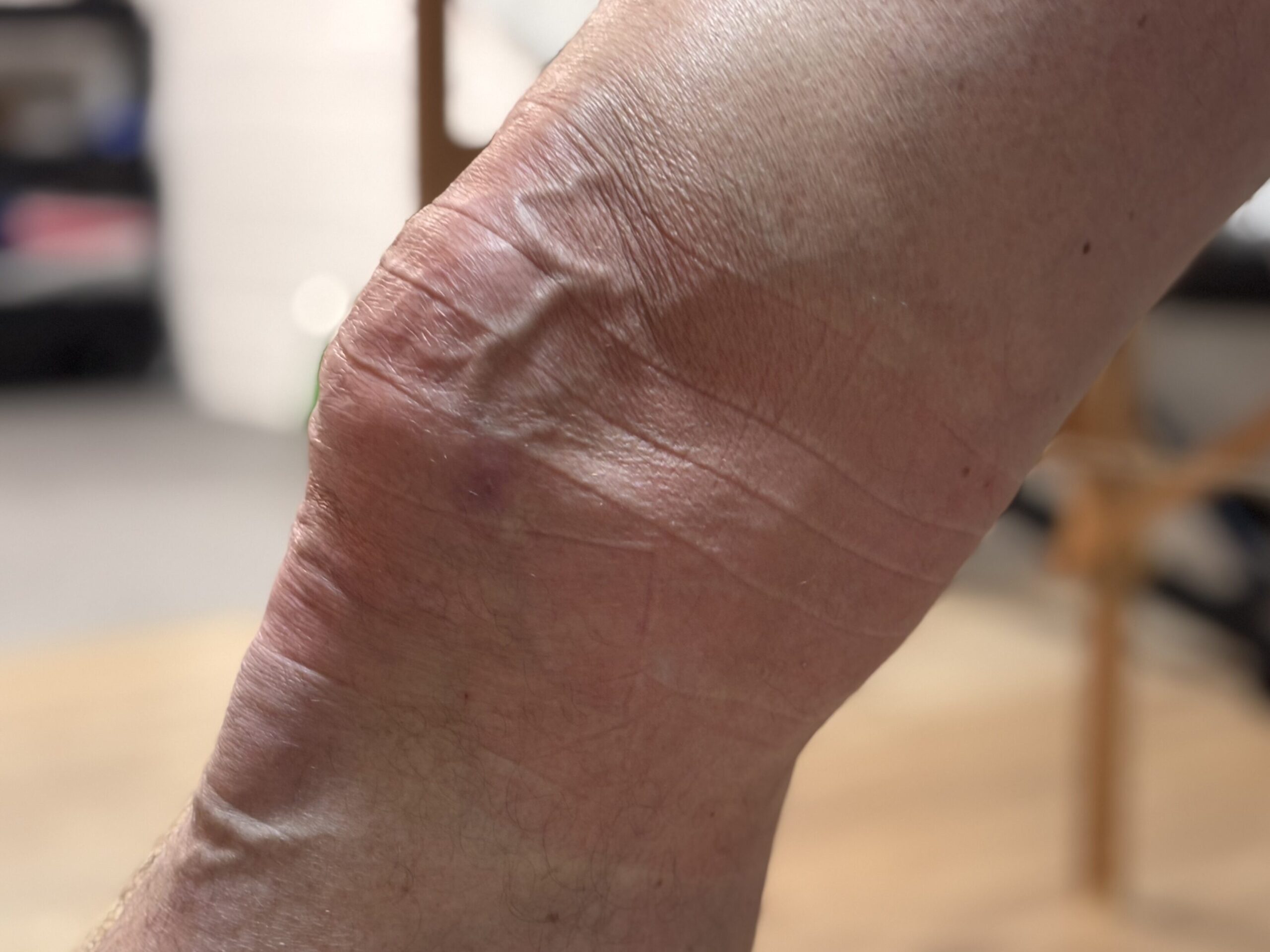 Das Gewebe ist nach dem Flossing sichtbar besser durchblutet.